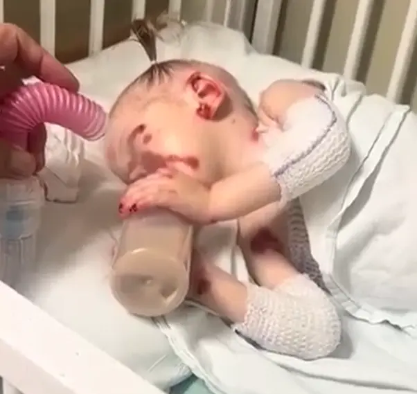 Agatha durante a rotina de curativos e cuidados diários